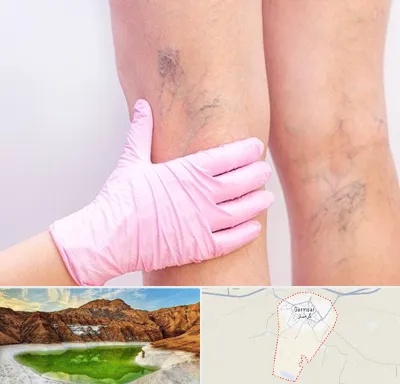 دکتر فوق تخصص واریس در گرمسار