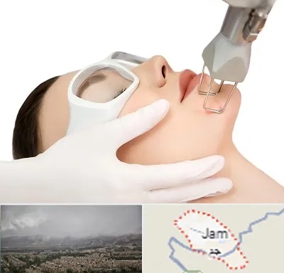 لیزر فرکشنال در جم