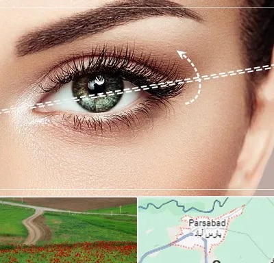 جراحی چشم گربه ای در پارس آباد