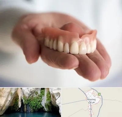 لیفت لثه با لیزر در خورموج