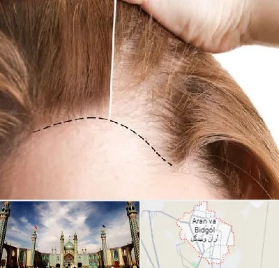 کاشت مو برای خانمها در آران و بیدگل