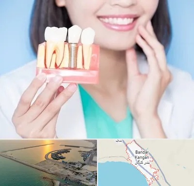 متخصص ایمپلنت در بندر کنگان