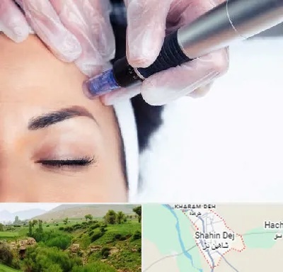 کلینیک مزوتراپی صورت در شاهین دژ