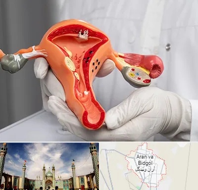 دکتر سرطان رحم در آران و بیدگل