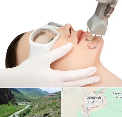 لیزر فرکشنال در اشنویه