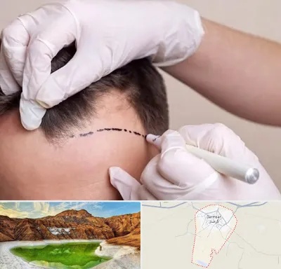 کاشت مو به روش SUT در گرمسار