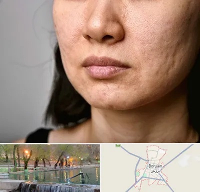 سابسیژن جای جوش در بروجن