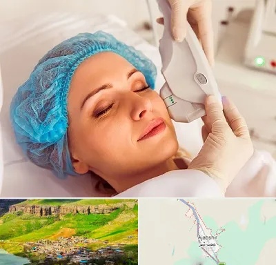 اکسنت در عجب شیر