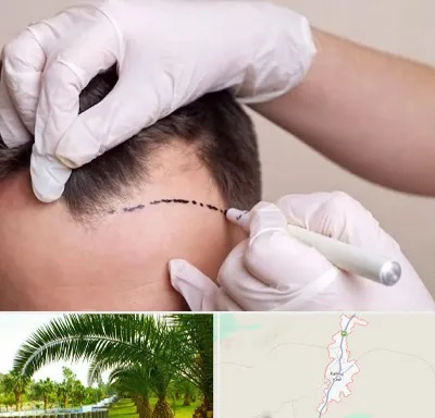 کاشت مو به روش SUT در کهنوج