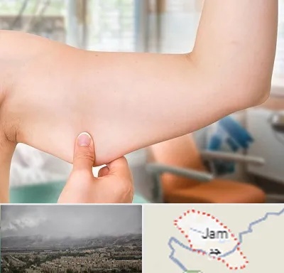 براکیوپلاستی در جم