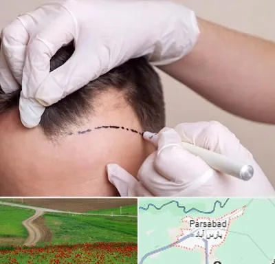 کاشت مو به روش SUT در پارس آباد