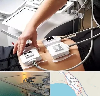 ترواسکالپ در بندر کنگان
