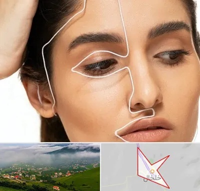 عمل بینی اقساطی در خلخال