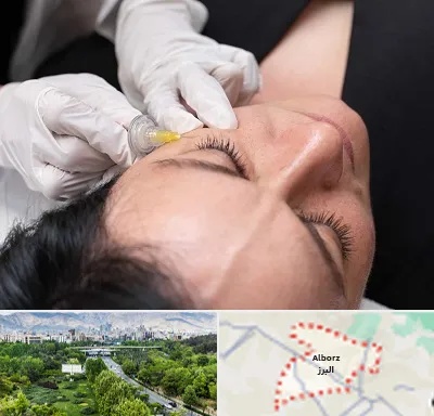 کربوکسی تراپی در البرز