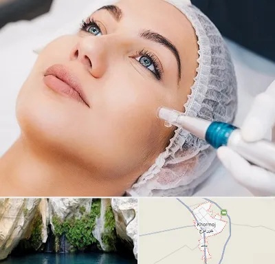 مزونیدلینگ در خورموج