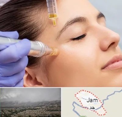 میکرونیدلینگ در جم