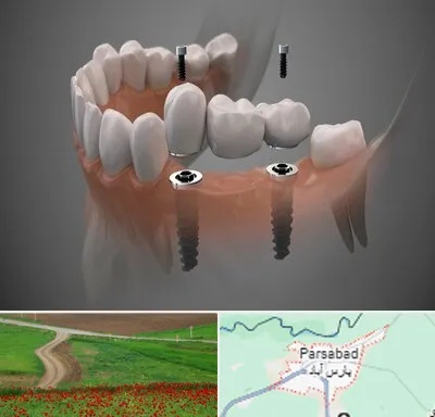 ایمپلنت دیجیتال در پارس آباد