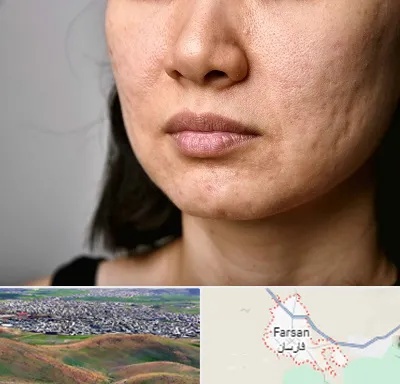 سابسیژن جای جوش در فارسان