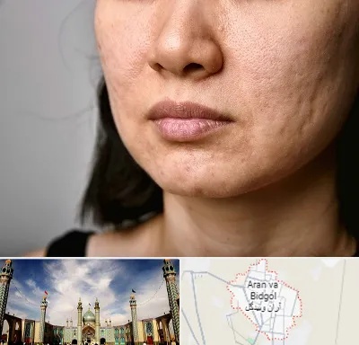 سابسیژن جای جوش در آران و بیدگل