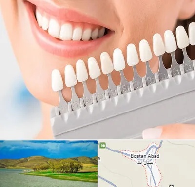 متخصص لمینت دندان در بستان آباد