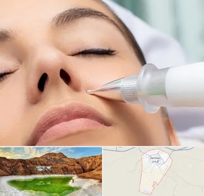 پلاسما جت بینی در گرمسار