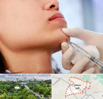 زاویه سازی صورت در البرز