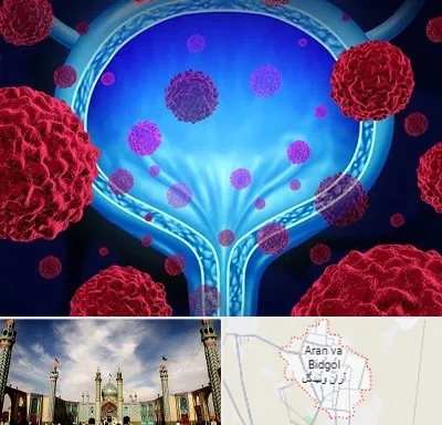 دکتر سرطان مثانه در آران و بیدگل