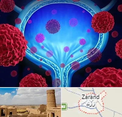 دکتر سرطان مثانه در زرند