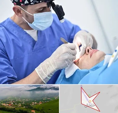 جراح سرطان چشم در خلخال