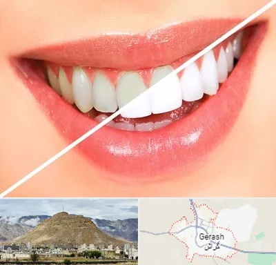 بلیچینگ دندان در گراش