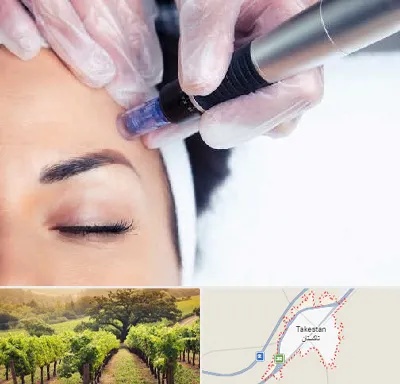 کلینیک مزوتراپی صورت در تاکستان