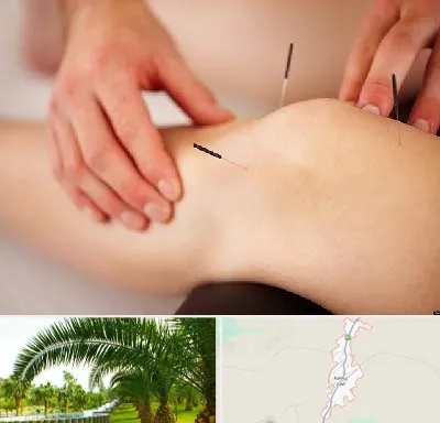 دکتر طب سوزنی برای لاغری در کهنوج