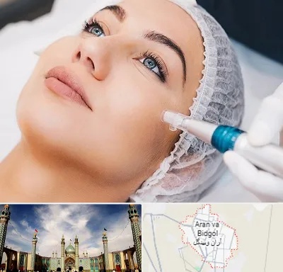 مزونیدلینگ در آران و بیدگل