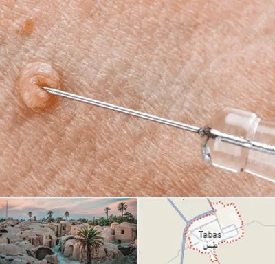 لیزر زگیل تناسلی در طبس