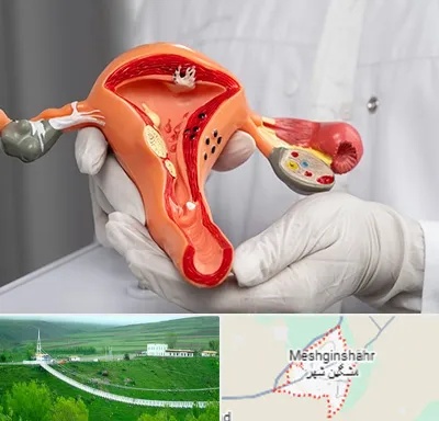 دکتر سرطان رحم در مشگین شهر