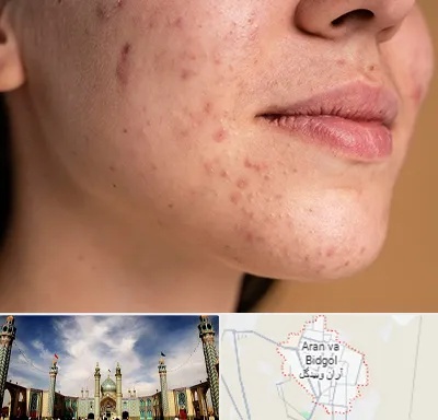 درمان جای جوش در آران و بیدگل