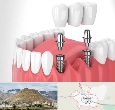 کاشت دندان در گراش