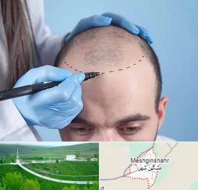 کاشت مو اقساطی در مشگین شهر