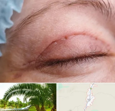 جراح پلک در کهنوج