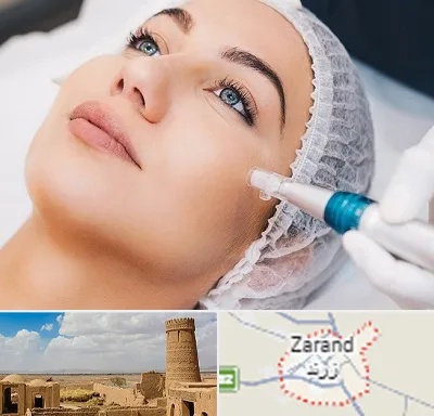 مزونیدلینگ در زرند