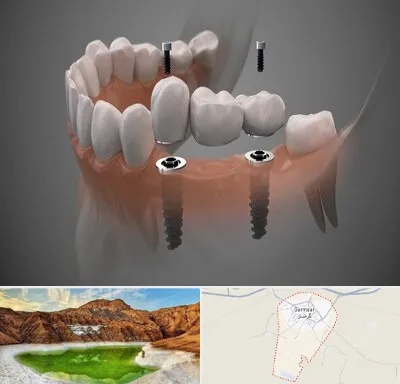 ایمپلنت دیجیتال در گرمسار
