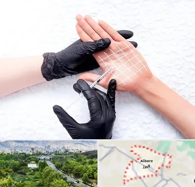 تزریق بوتاکس کف دست در البرز