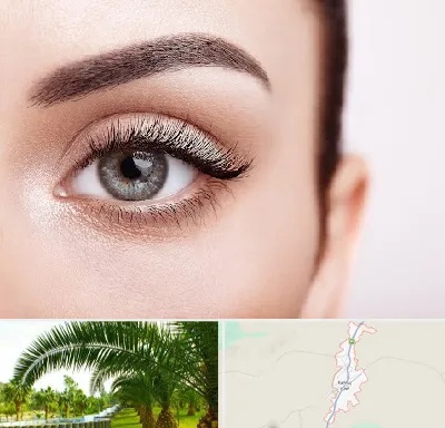 فوق تخصص عنبیه در کهنوج