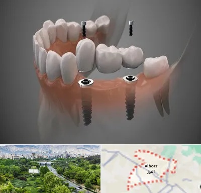 ایمپلنت دیجیتال در البرز