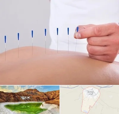 دکتر طب سوزنی در گرمسار