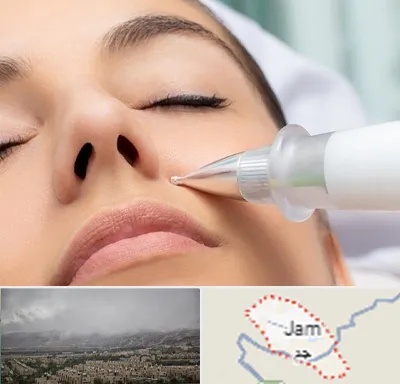 پلاسما جت بینی در جم