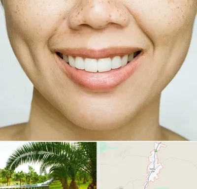 عمل چال گونه در کهنوج