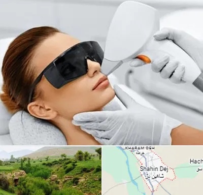 مرکز لیزر مو در شاهین دژ