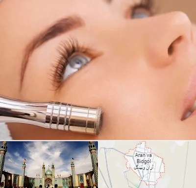 میکرودرم در آران و بیدگل