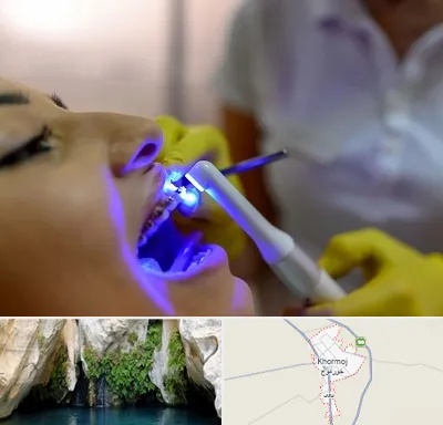 دندانپزشکی با لیزر در خورموج